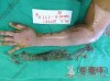 巴西女子手臂烧伤后植入鱼皮 有望快速恢复